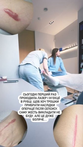 
Тяжелобольная Катерина Тышкевич показала страшные рубцы на теле после сепсиса
