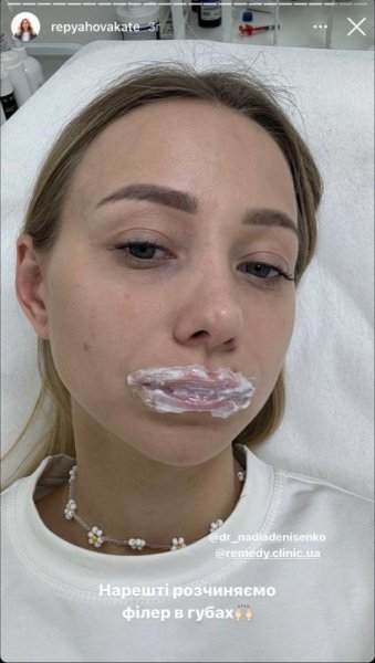 
Жена Виктора Павлика неожиданно уменьшила губы и показала, как выглядит
