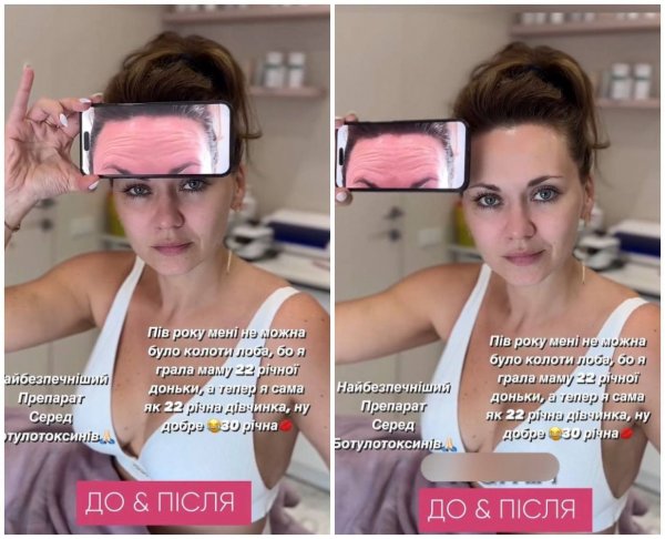 
Анна Саливанчук уколола ботокс в лоб и похвасталась результатом: фото до и после
